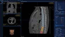 爱康AI精准识别关节问题 守护中老年骨骼健康 