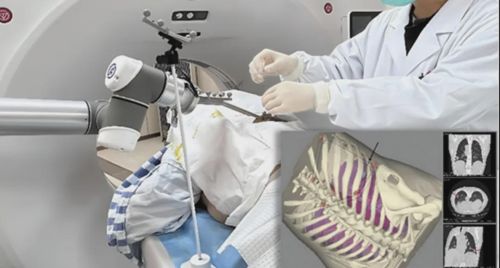 珠海首例机器人穿刺手术成功，AI主刀5分钟完成肺结节切除