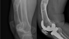 锟铻®机器人精准矫正内翻膝，解放军总医院第一医学中心完成机器人辅助全膝置换术