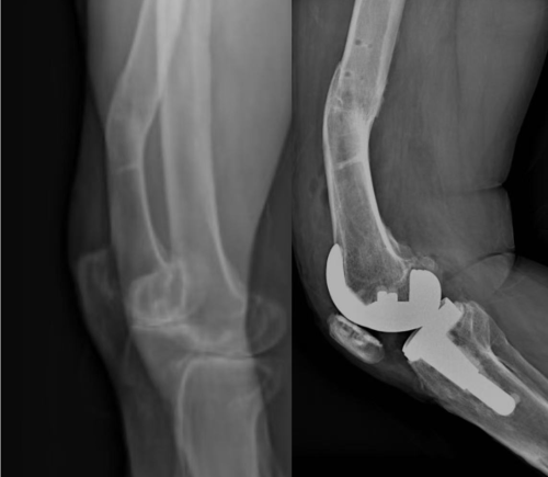 锟铻®机器人精准矫正内翻膝，解放军总医院第一医学中心完成机器人辅助全膝置换术