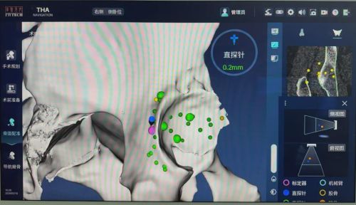 九年股骨头坏死患者在锟铻®机器人辅助下实现0.5毫米精准重建