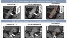 阿里巴巴发布创新癌症AI模型，助力肠癌筛查 